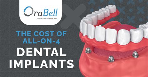 dental implants prices overseas.